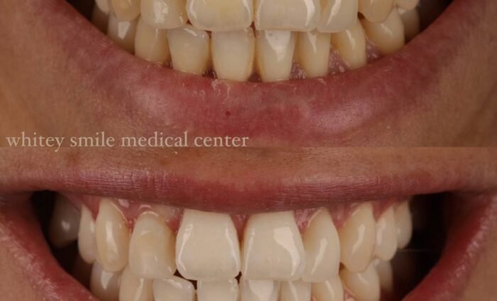 Removal of Plaque, Tartar, and Stains