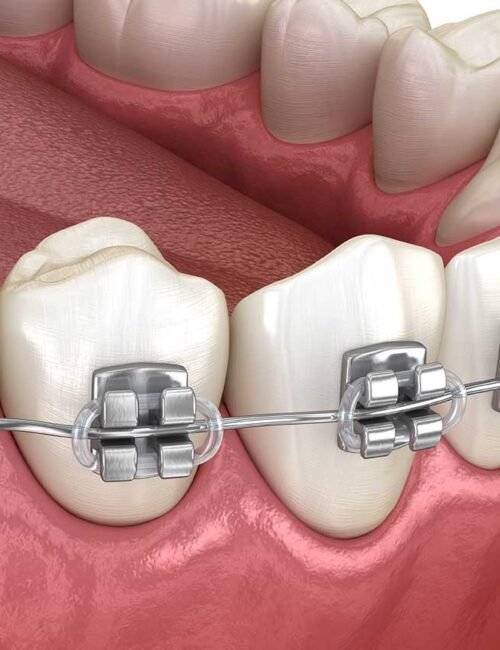 best-orthodontist-near-me-london