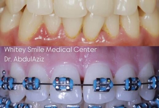Metal Braces and Tensile Strength | RAK