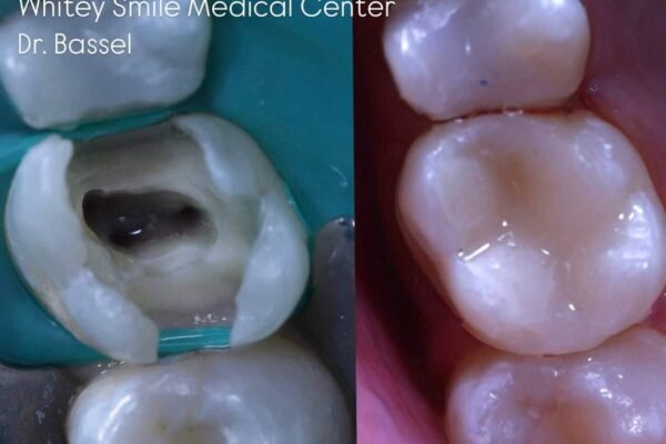 Best Bond Filling Materials for Lasting Dental Health | RAK